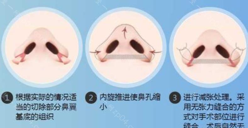 隆鼻手术费用详解，价格因素与考量