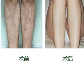 脱毛费用详解，价格因素、影响因素与选择策略