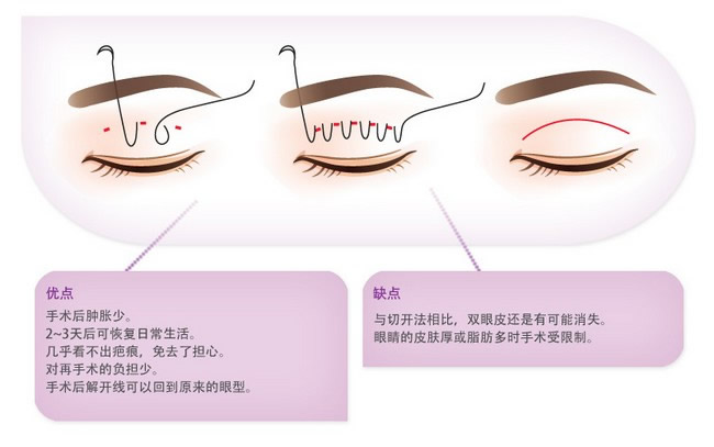 埋线法双眼皮手术，现代美容领域的新选择