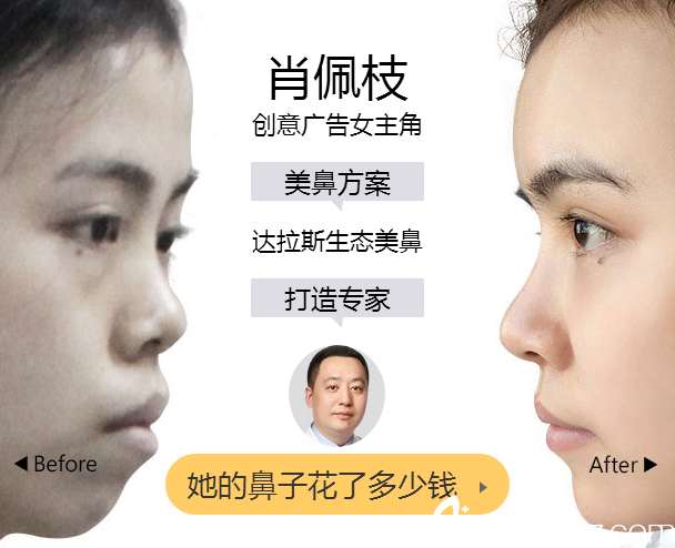 隆鼻失败修复，重塑自信的必经之路