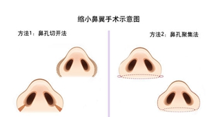 探索鼻子整形，理解过程、风险与预期效果