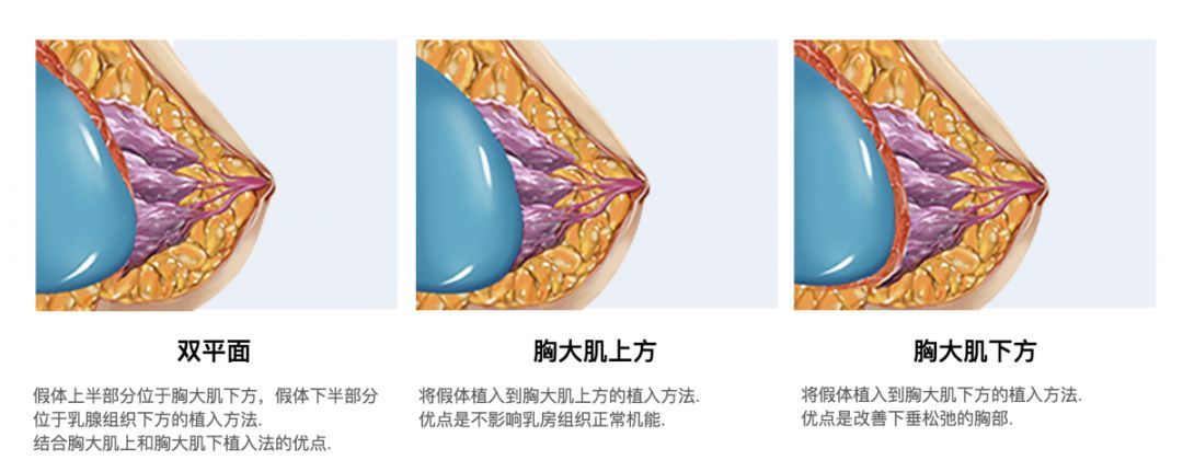 隆胸好不好，全面解析与深度探讨