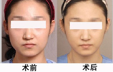探索注射Botox瘦脸，美丽的新选择