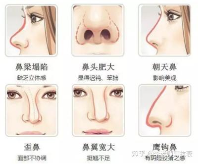 全面解析隆鼻手术费用，多少钱才能实现完美鼻型？