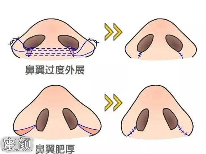 鼻子缩小整形手术，重塑自信与美丽