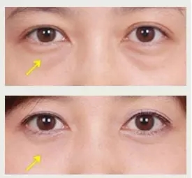 去眼袋手术，重塑眼部魅力的专业解决方案