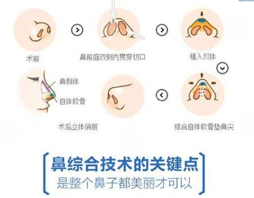 隆鼻手术，优缺点全面解析