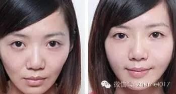 额部填充术，重塑面部轮廓的美学革命