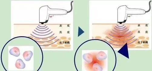 祛斑副作用，了解并预防潜在风险
