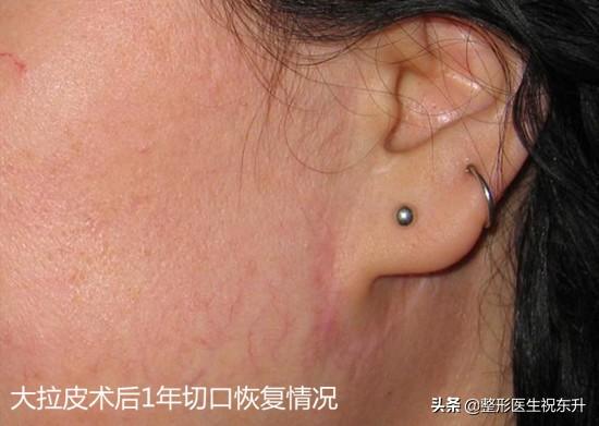 拉皮除皱手术费用全面解析，多少钱？