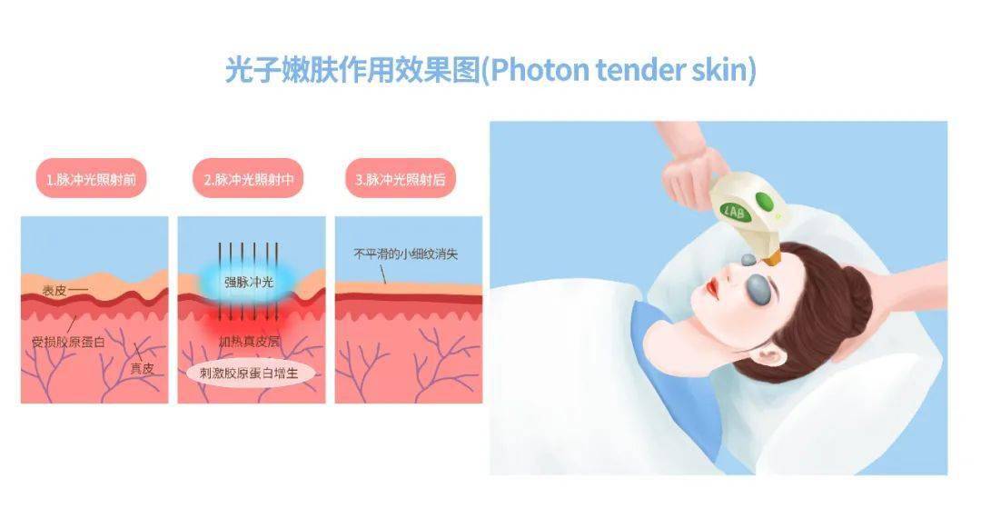光子嫩肤的价格究竟是多少？全面解析费用因素