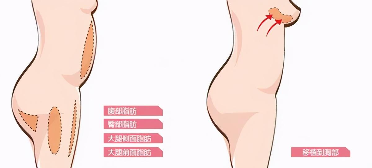 假体隆胸的优势及其吸引力