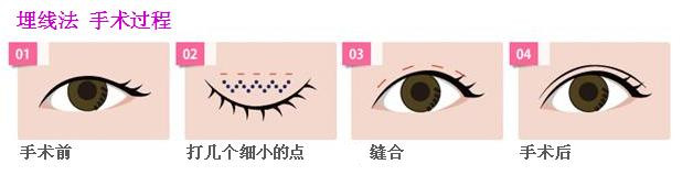 双眼皮埋线法，美丽之道的探索