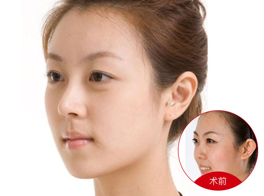 鼻尖整形的魅力与探索