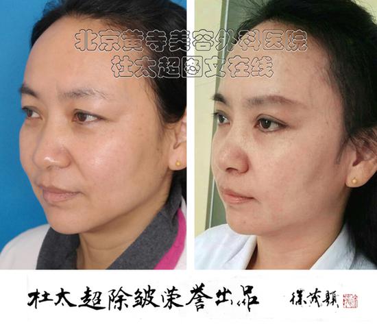 生物除皱针，重塑美丽容颜的新选择