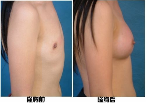 隆胸手术费用概览，了解隆胸大概要多少钱
