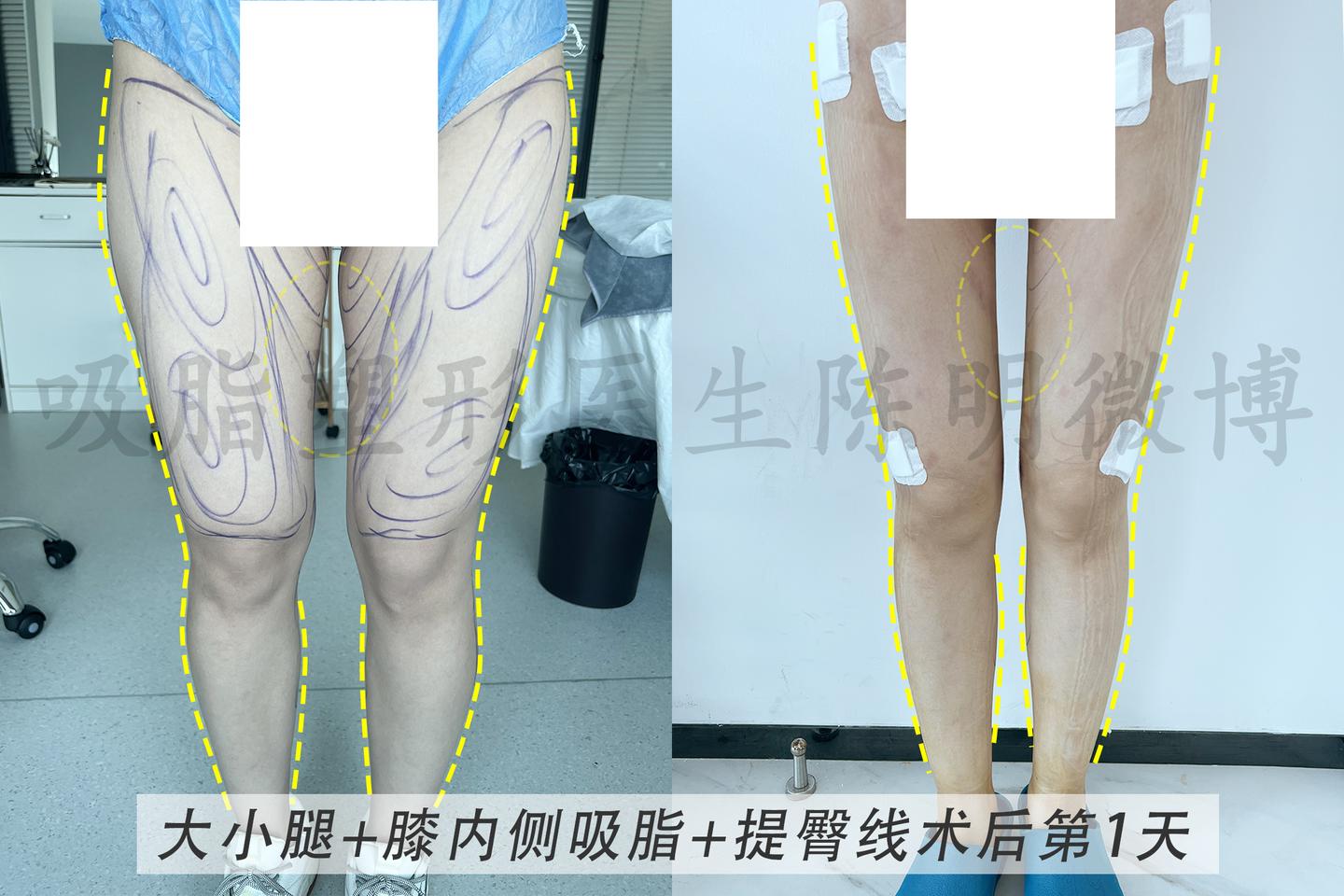 吸脂提臀术，重塑美丽臀线的新选择