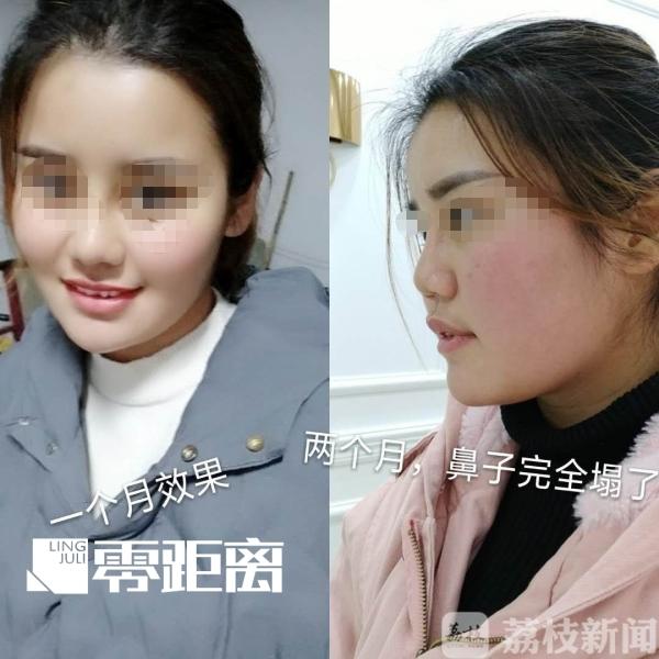 隆鼻手术费用
