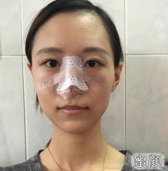 硅胶垫鼻梁，重塑自信美丽的新选择