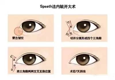 开眼角