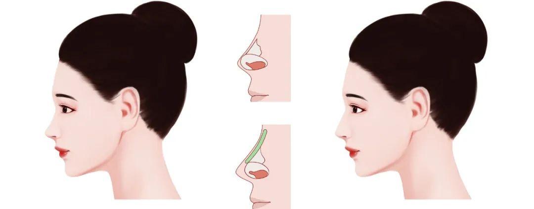 隆鼻材料的选择，哪种材料更适合你？