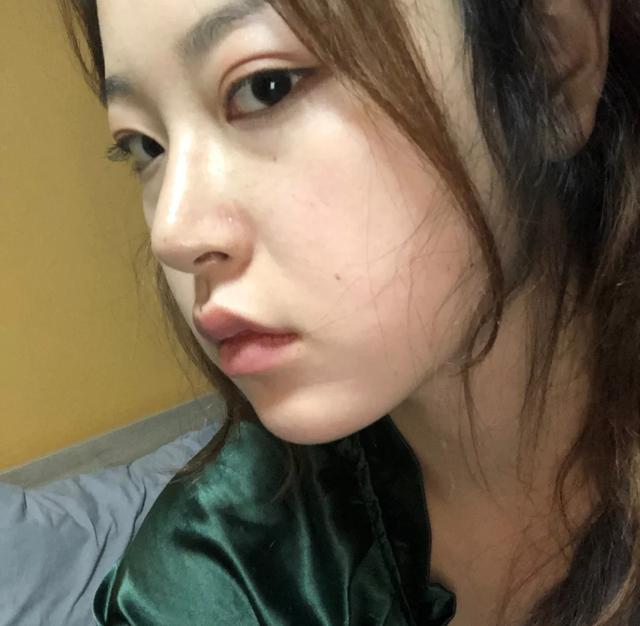 玻尿酸隆鼻注意事项，打造完美鼻梁的关键步骤