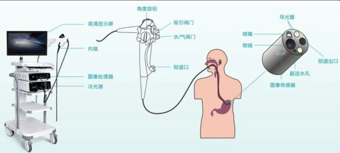 内窥镜技术在除皱领域的应用，内窥镜除皱