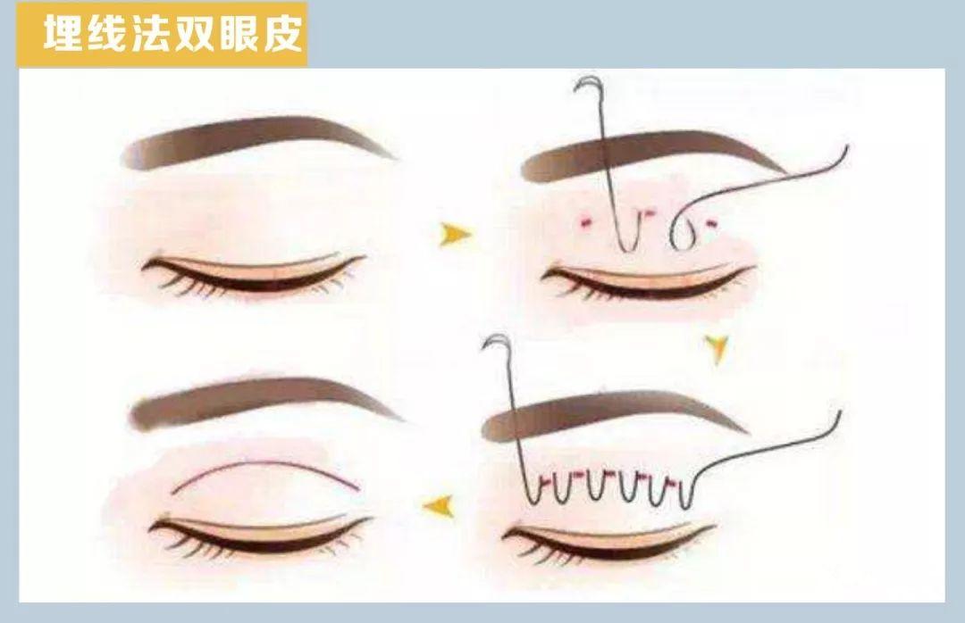 高分子压双眼皮手术，现代美容技术的崭新探索