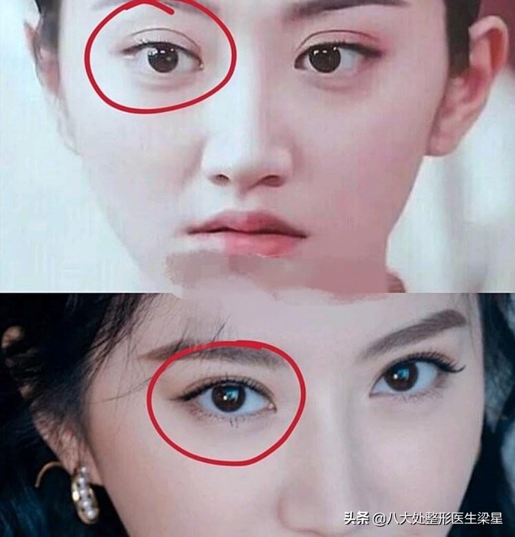 双眼皮手术费用详解，价格因素与个体差异