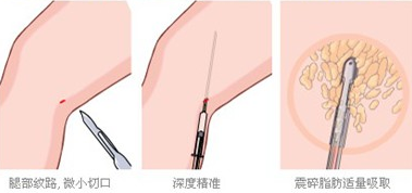 瘦大腿吸脂手术价格详解，因素、费用及注意事项