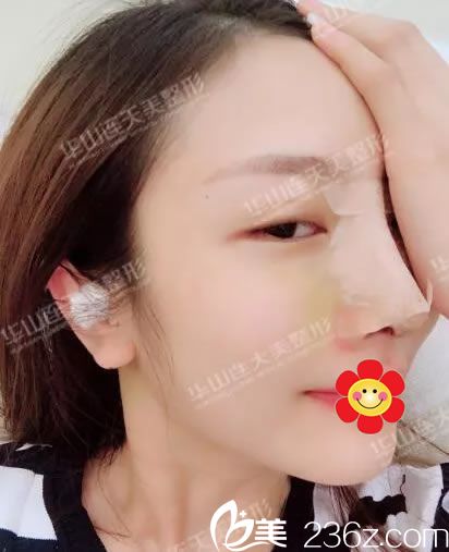 隆鼻假体修复，重塑自信的鼻型之美