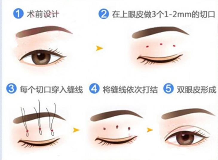 双眼皮塑造美丽，割双眼皮手术费用解析