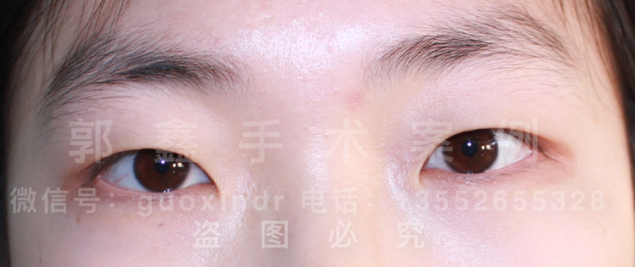 韩式双眼皮拆线，美丽之路的细节解析
