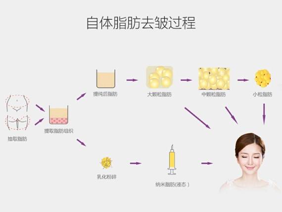 自体脂肪注射除皱价格，全面解析费用因素与选择策略