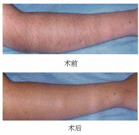 小腿激光脱毛