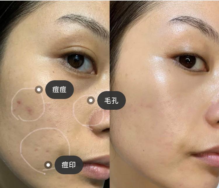 注射胶原蛋白的副作用探讨