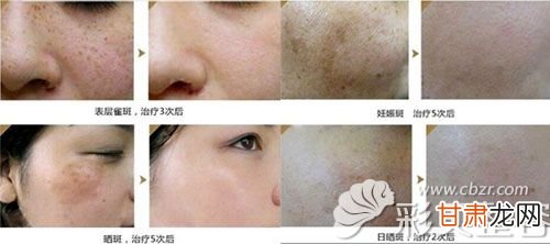 激光祛斑，价格因素详解