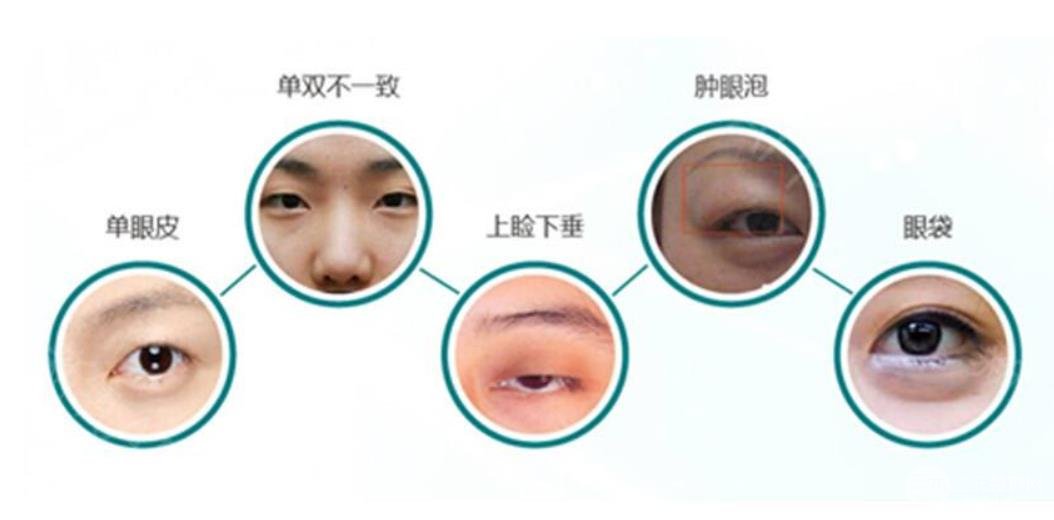 眼睛整容，重塑美丽视界的新趋势