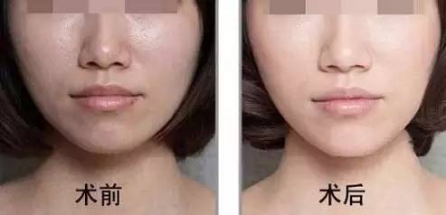 光子嫩肤的价格解析，做一次需要多少钱？