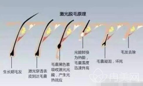 激光脱毛费用多少，全面解析脱毛成本与因素