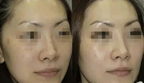激光美白嫩肤，重塑肌肤光彩的科技新宠