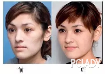 自体脂肪注射隆鼻，探索现代鼻整形的新技术
