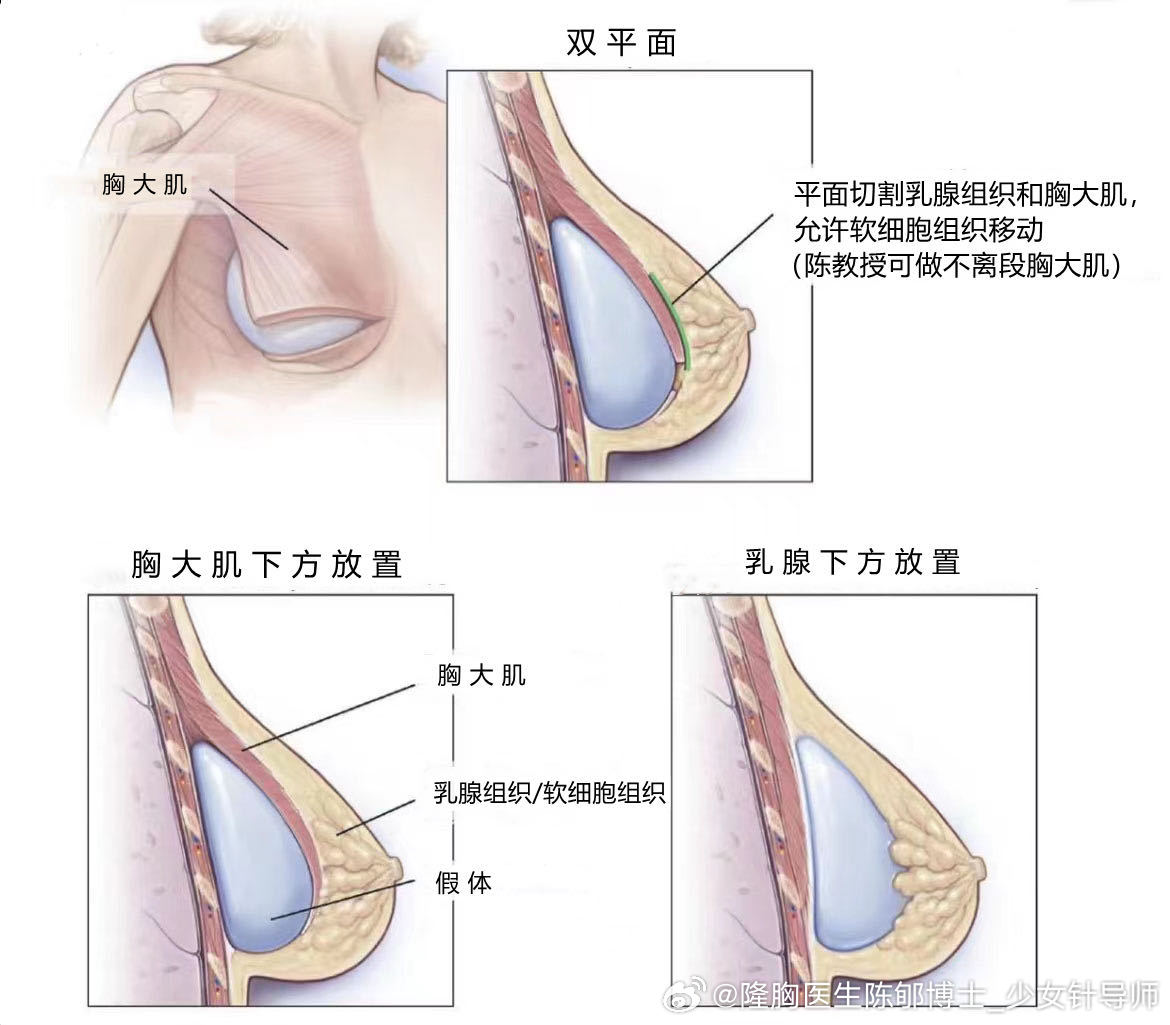 双平面隆胸，重塑完美曲线的艺术