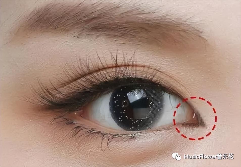 开眼角手术