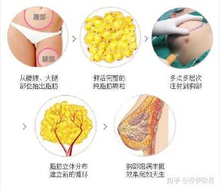 隆胸手术，探索、理解与选择