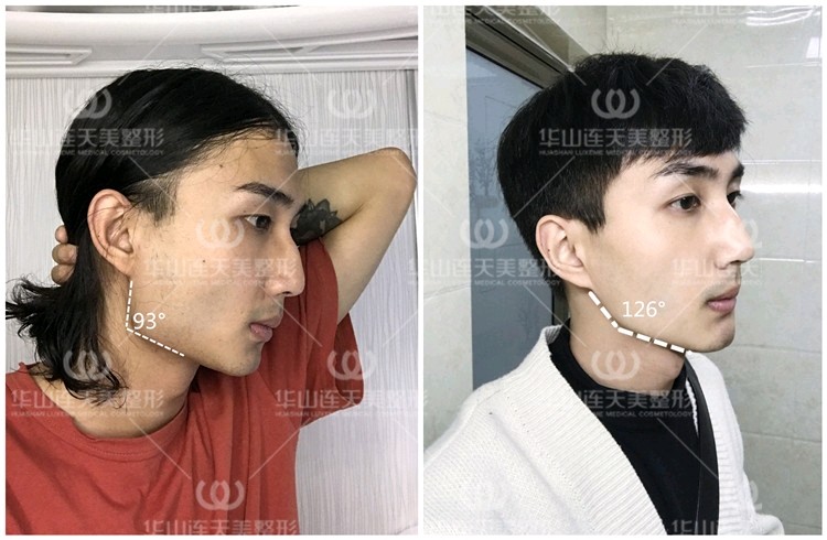 男性过大下颌角整形的探索与实践