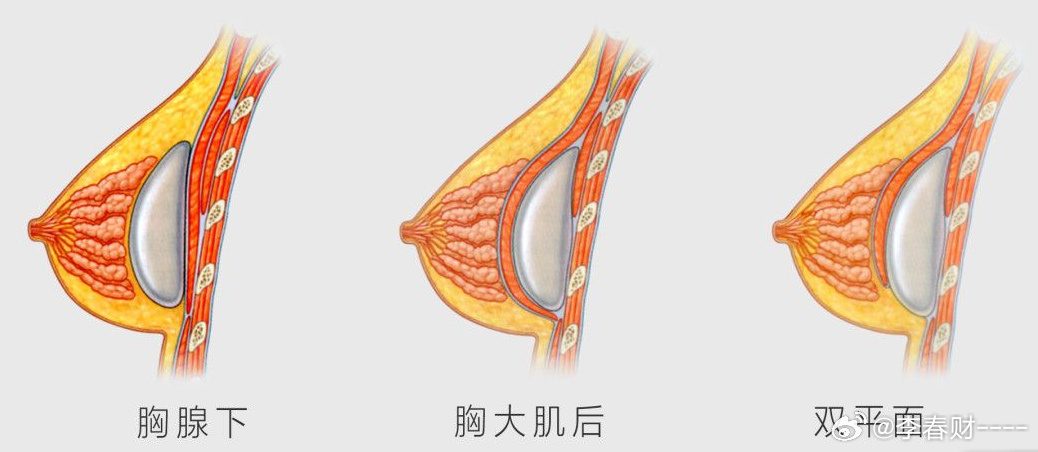 丰胸整形的费用全面解析