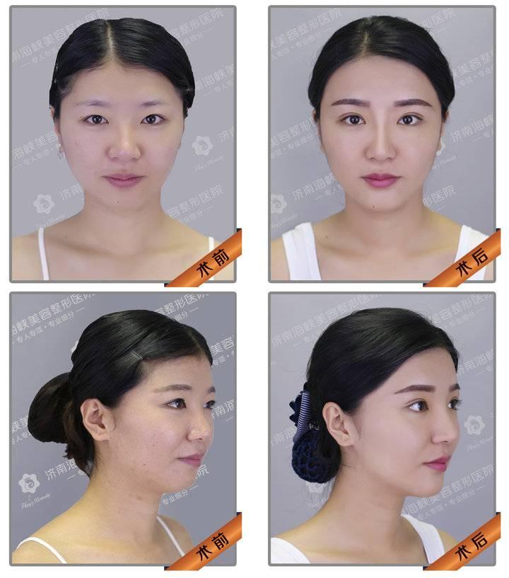 下巴整形美容，塑造完美轮廓的艺术之旅