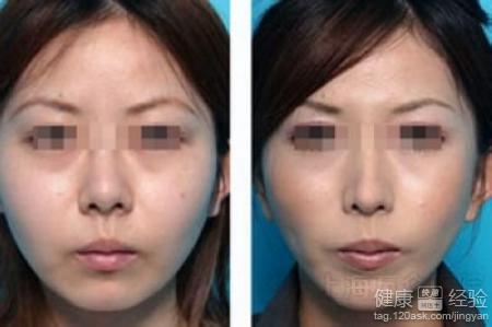 瘦脸针是否会反弹，深度解析与应对之策
