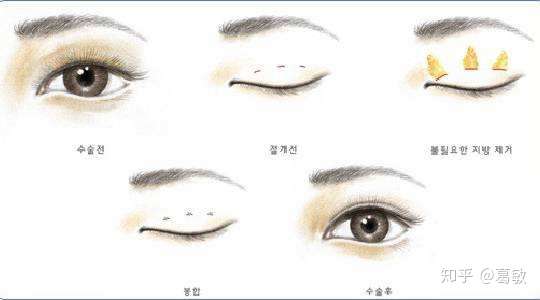 韩式双眼皮，永恒之美还是暂时之韵？